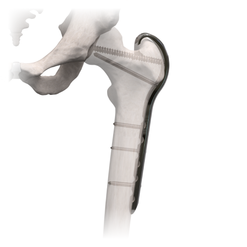 Grandes Fragmentos com Bloqueio