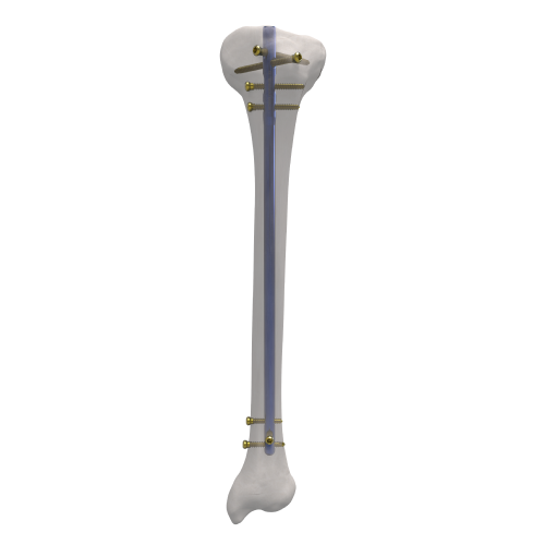 Hastes Intramedulares