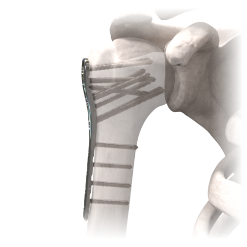 Pequenos Fragmentos com Bloqueio (TrauLocking)