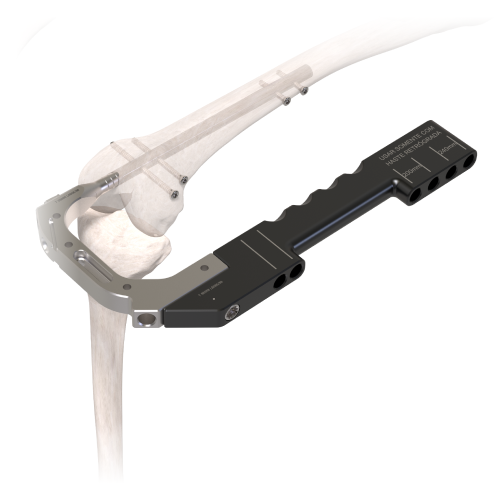 Haste Intramedular Femoral Retrógrada | Anterógrada