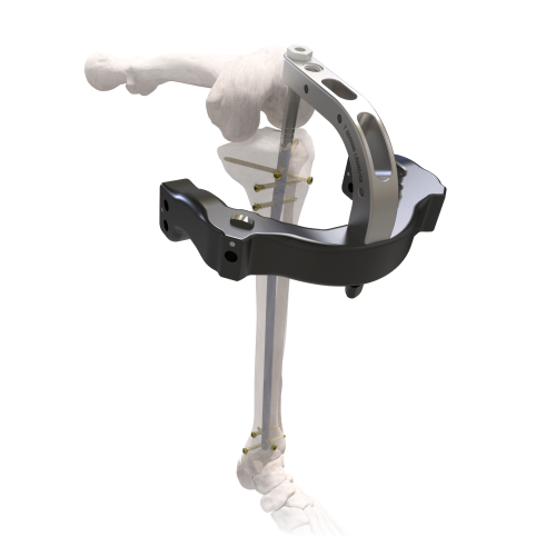Haste Intramedular Tibial Cross Lock