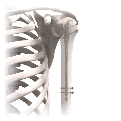 Haste Intramedular Úmero Traunail