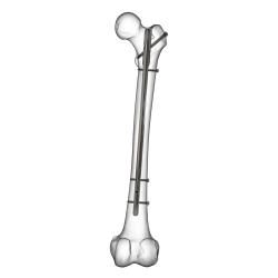Haste Intramedular Femoral