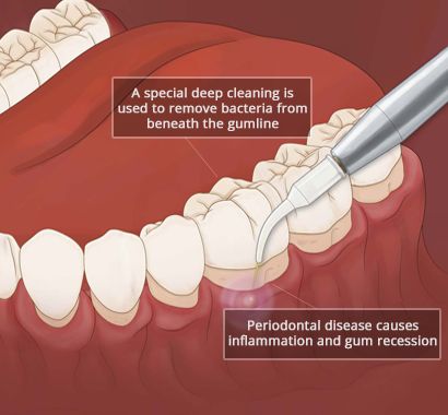Periodontal Treatment: Addressing Gum Disease Effectively