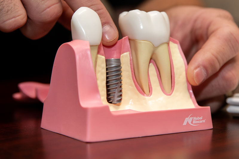 Understanding Dental Implants: A Guide to Replacing Missing Teeth